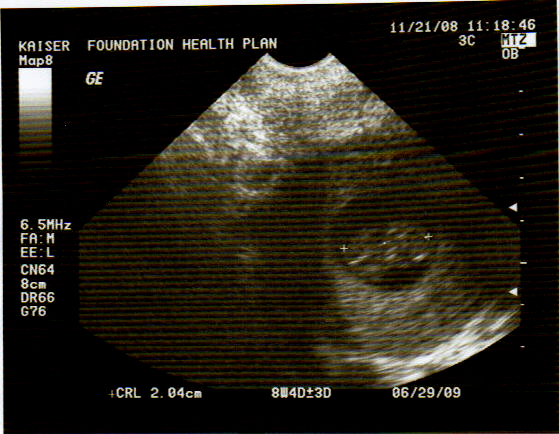Ultrasound 9 Weeks